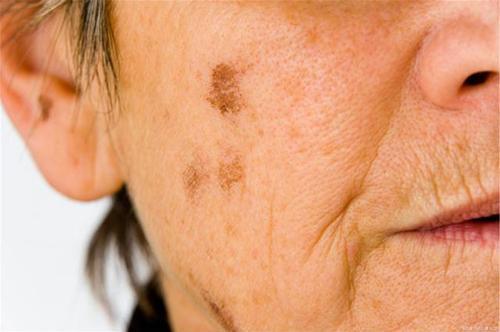 消除老年斑的常用方法有哪些 