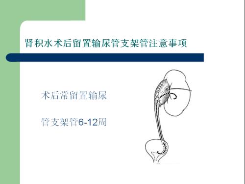 输尿管支架 