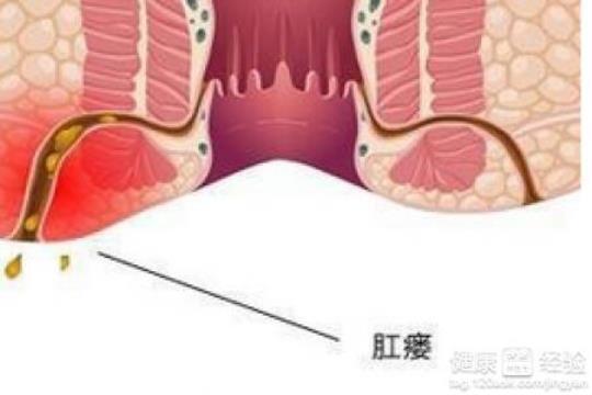 肛瘘手术后吃什么好 肛瘘是什么症状表现