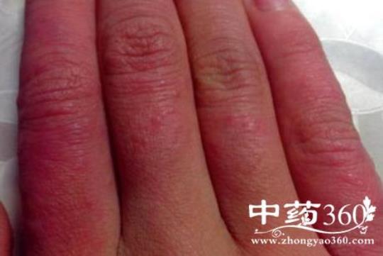 治冻疮的方法 冻疮方法