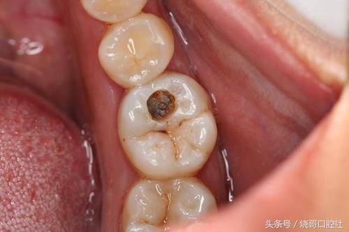 补虫牙流程 