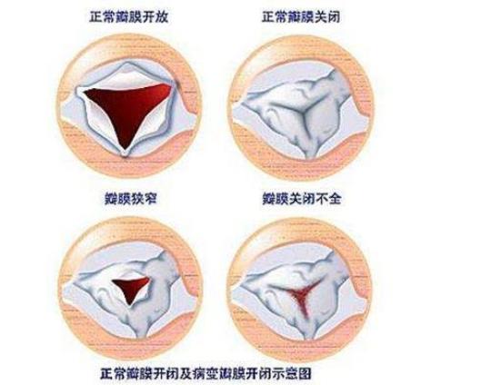 风湿性心脏病能吃醋蛋液吗