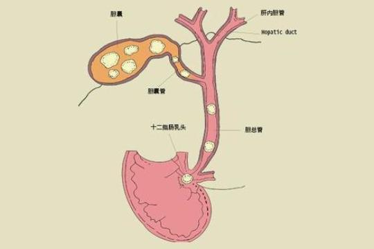 胆结石可以喝豆浆吗？