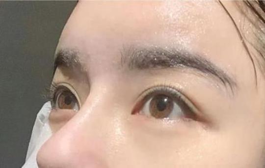 割完双眼皮忌酱油多久？